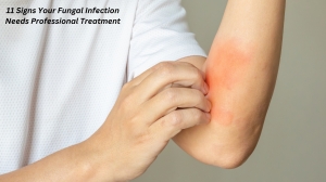 When to Seek Treatment for Fungal Infections When to Seek Treatment for Fungal Infections